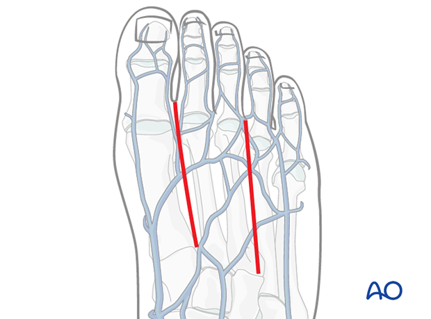 If several metatarsals are to be approached two incisions are used, one between the 1st and 2nd and/or one between the 3rd and 4th.