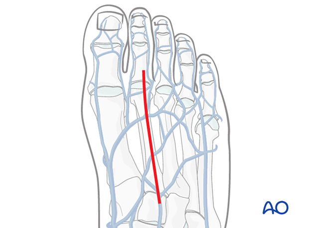 Skin incision of the dorsal approach to the second metatarsal