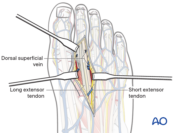 Deep dissection of the dorsal approach to the second metatarsal
