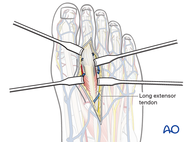 Deep dissection of the dorsal approach to the second metatarsal with retraction of the EDL tendon and exposure of the second metatarsal