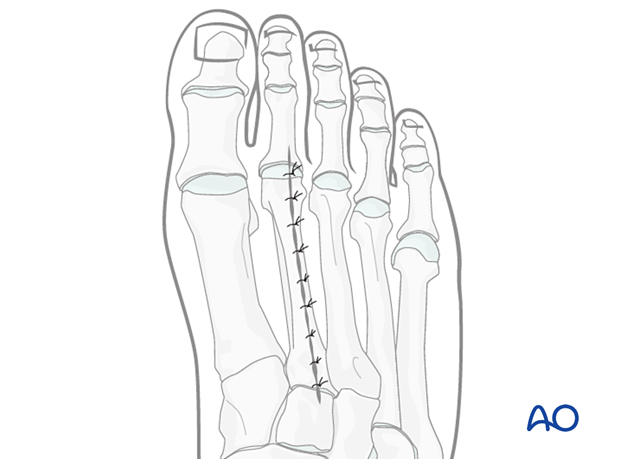 Skin closure of the dorsal approach to the second metatarsal