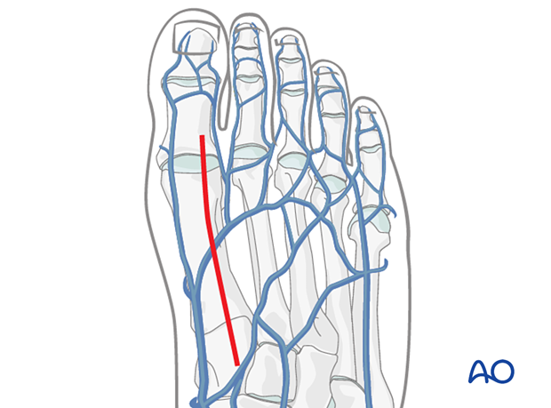 A skin incision of the dorsal approach to the first metatarsal