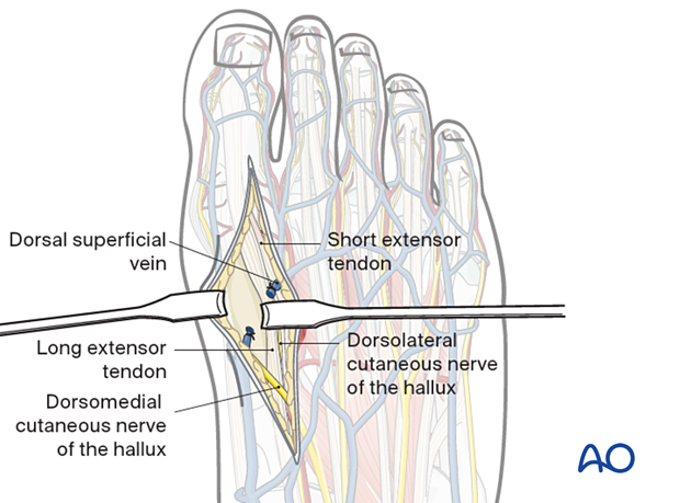 Deep dissection of the dorsal approach to the first metatarsal