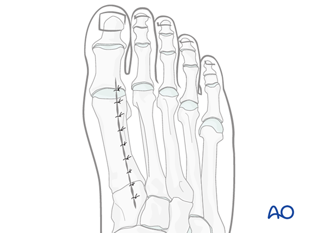 Skin closure of the dorsal approach to the first metatarsal