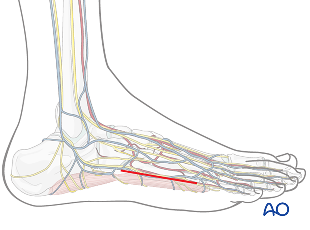 A skin incision of the lateral approach to the fifth metatarsal