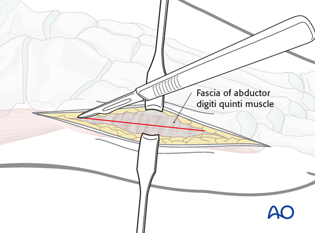 Exposure of the fascia over the abductor digiti quinti muscle belly and its incision longitudinally