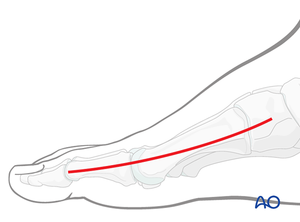 A skin incision of the medial approach to the first metatarsal