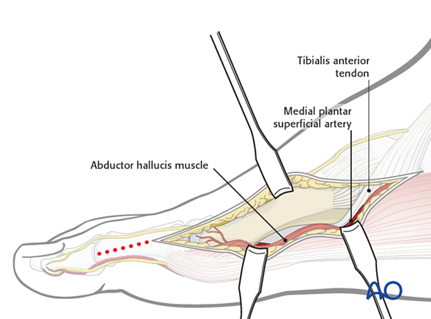 Plantarwards retraction of the dorsal edge margin of the abductor hallucis muscle