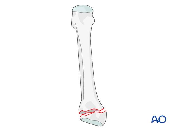 Proximal simple extraarticular fracture of a metatarsal