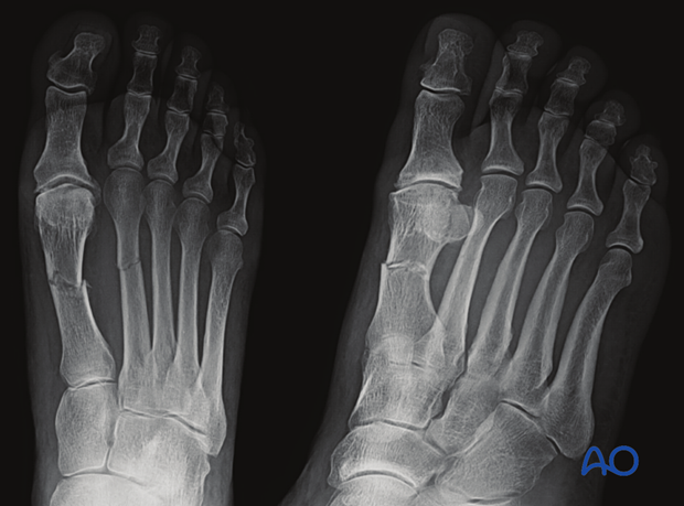 AP and oblique x-rays of a transverse diaphyseal fracture of the first metatarsal