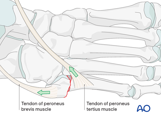 The Jones fracture is an extraarticular fracture.