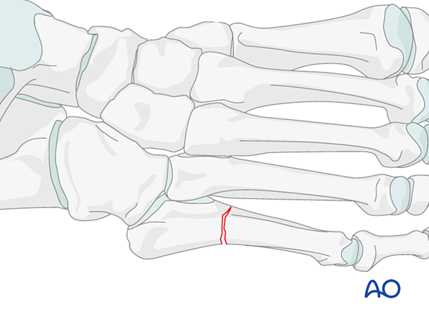 Proximal extraarticular fracture of the 5th metatarsal