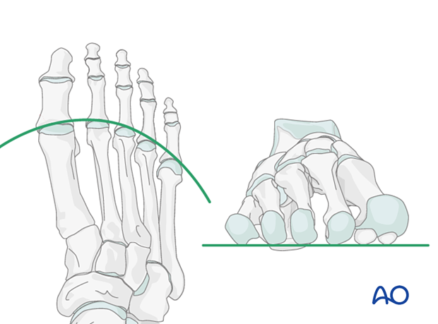 Anatomical alignment of the metatarsal heads