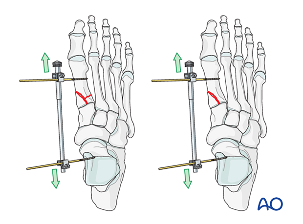 Mini distractor applied to improve visualization of a proximal articular fracture of the 1st metatarsal