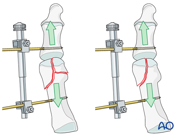 Mini distractor applied to improve visualization of a distal articular fracture of the 1st metatarsal