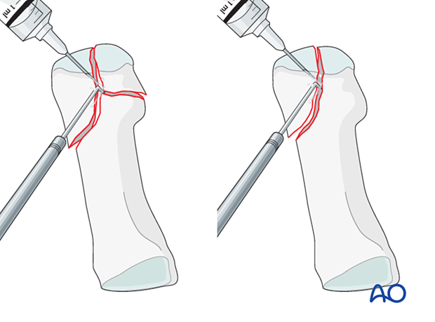 Irrigation of a distal articular fracture of the 1st metatarsal