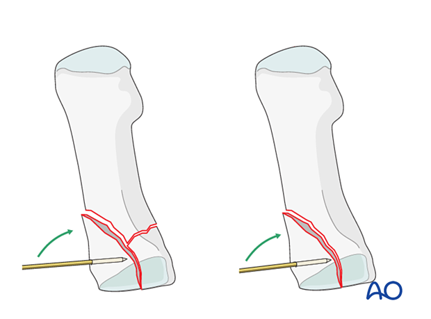 Joystick reduction of a proximal articular fracture of the 1st metatarsal