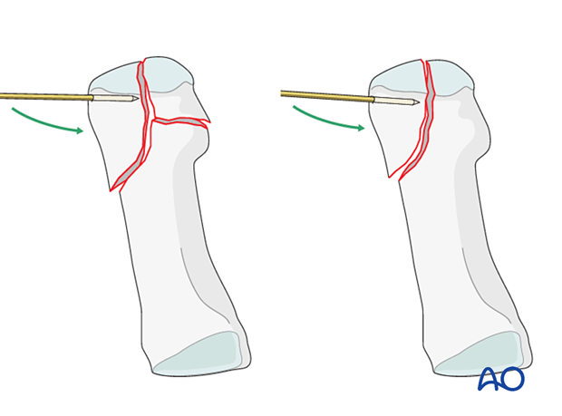 Joystick reduction of a distal articular fracture of the 1st metatarsal