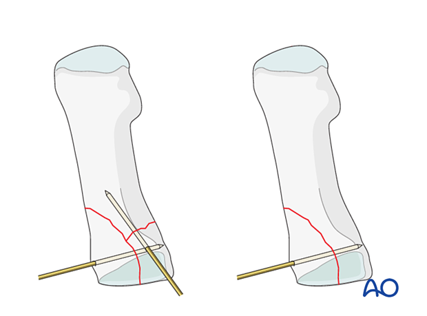 Preliminary K-wire fixation of a proximal articular fracture of the 1st metatarsal