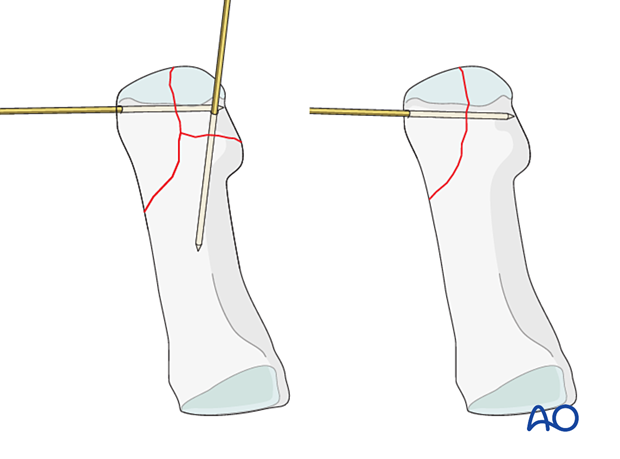 Preliminary K-wire fixation of a distal articular fracture of the 1st metatarsal