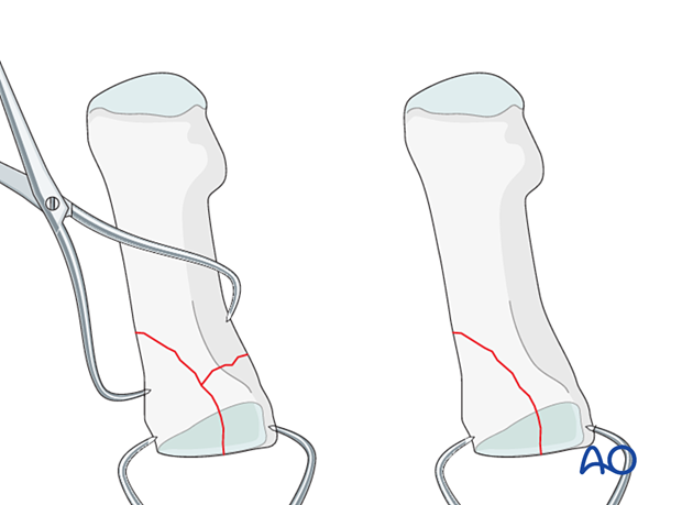 Reduction and preliminary fixation with reduction forceps of a proximal articular fracture of the 1st metatarsal