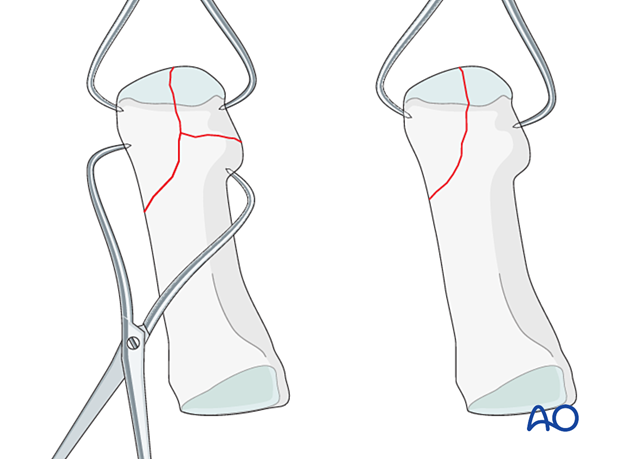 Reduction and preliminary fixation with reduction forceps of a distal articular fracture of the 1st metatarsal