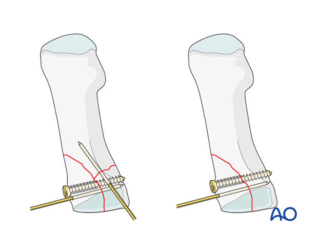 Screw fixation of the articular block in a proximal articular fracture of the 1st metatarsal