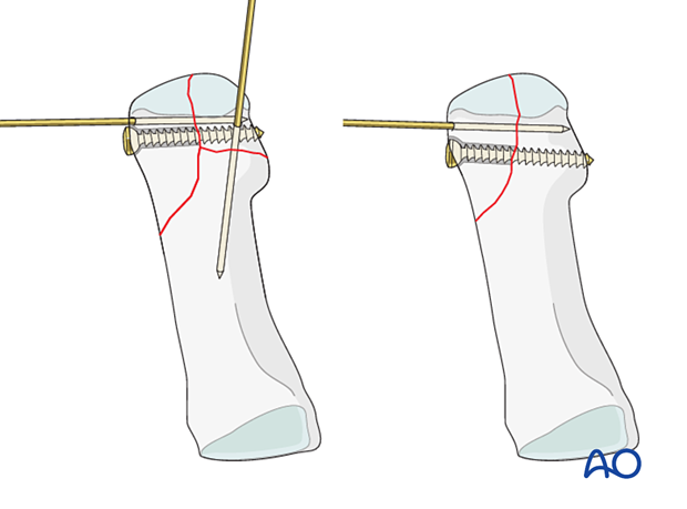 Screw fixation of the articular block in a distal articular fracture of the 1st metatarsal