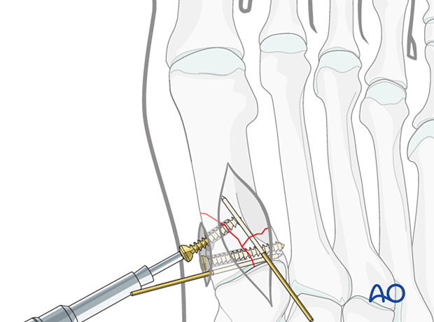 Percutaneous screw insertion for fixation of a proximal articular fracture of the 1st metatarsal