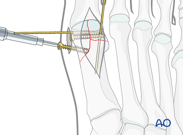 Percutaneous screw insertion for fixation of a distal articular fracture of the 1st metatarsal