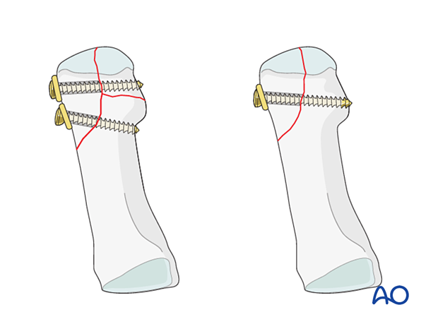 Screw fixation of a distal articular fracture of the 1st metatarsal in osteoporotic bone