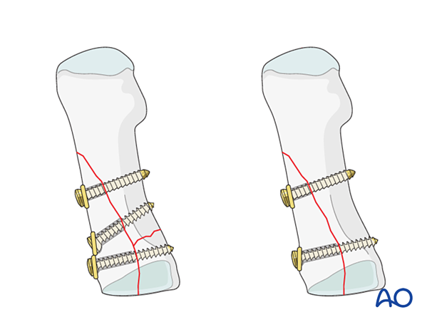 Screw fixation of a proximal articular fracture of the 1st metatarsal with long oblique fracture extension