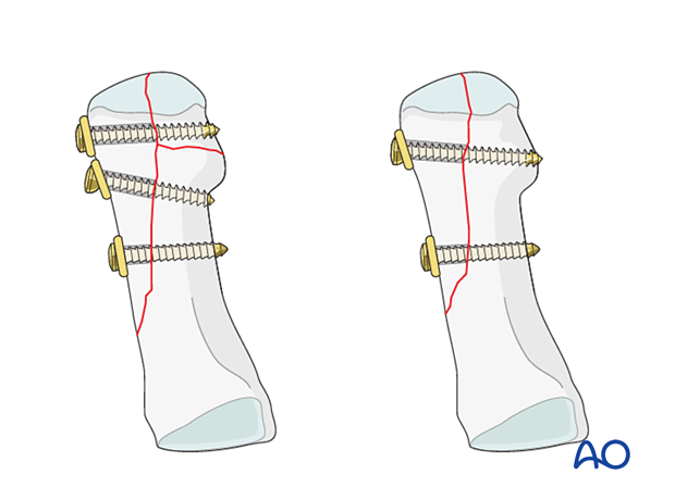 Screw fixation of a distal articular fracture of the 1st metatarsal with long oblique fracture extension