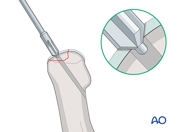 Countersinking of the articular cartilage for screw fixation of a small osteochondral fragment of the 1st metatarsal distal articular surface