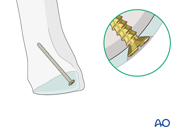 Screw fixation of a small osteochondral fragment of the 1st metatarsal proximal articular surface