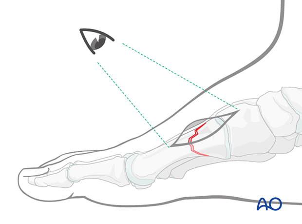 Confirming anatomical reduction of a proximal articular fracture of the 1st metatarsal under direct visualization