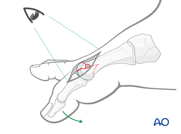 Confirming anatomical reduction of a distal articular fracture of the 1st metatarsal under direct visualization