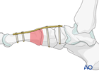 Dorsal spanning plate fixation of a proximal articular fracture of the first metatarsal