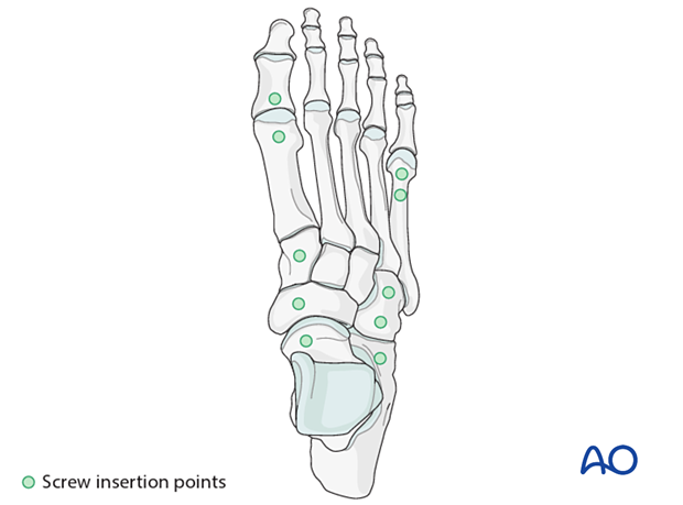 Screw insertion points for dorsal spanning plate fixation of proximal articular metatarsal fractures