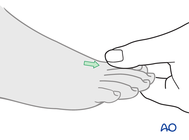 Manual traction for closed reduction of a proximal articular fracture of the first metatarsal