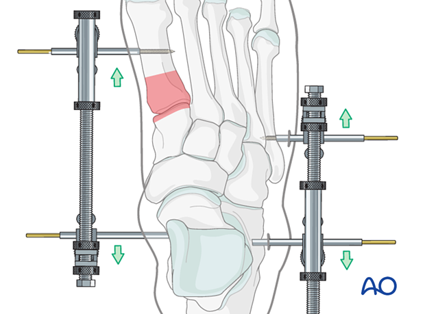External fixation of a proximal articular fracture of the first metatarsal