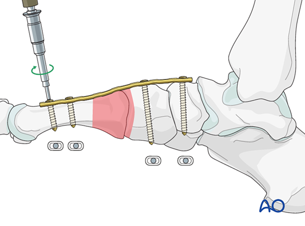Screw insertion for dorsal spanning plate fixation of a proximal articular fracture of the 1st metatarsal