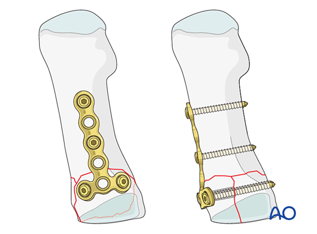 Fixation of a proximal complete articular fracture of the first metatarsal with a nonlocking T-plate