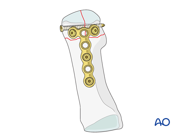 87 P110 Nonlocking plate with or without lag screws