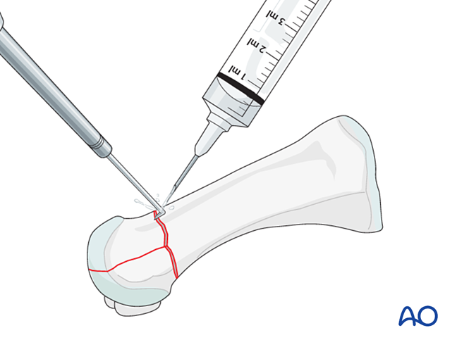 Locking plate with/without lag screw for Distal articular fractures of ...