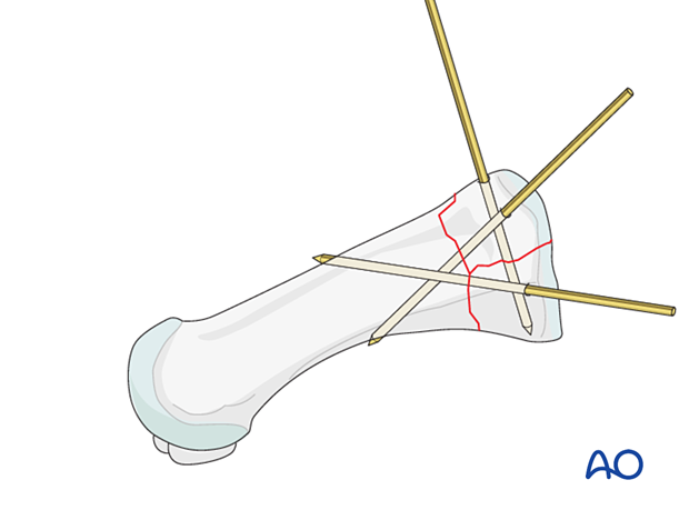 Preliminary K-wire fixation of a proximal complete articular fracture of the 1st metatarsal