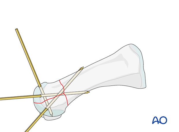 Preliminary K-wire fixation of a proximal complete articular fracture of the 1st metatarsal