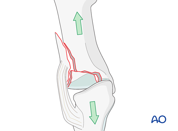 Traction on an impacted proximal complete articular fracture of the 1st metatarsal