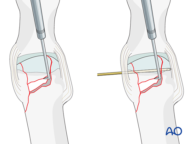 Reduction of the articular surface of an impacted proximal complete articular fracture of the 1st metatarsal