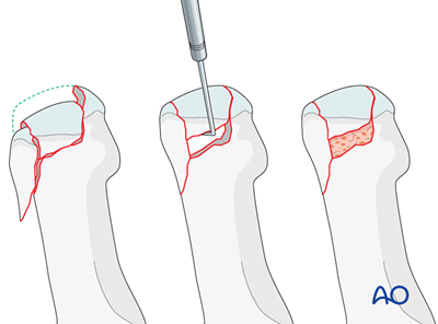Lag screw fixation for Distal articular fractures of the 1st to 4th ...